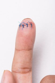 closeup wound with surgical stitch on the finger