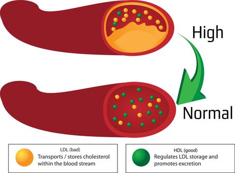 Turning high level of atherosclerotic plaque in blood vessel into normal level. medical vector infographics