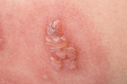 Shingles, Zoster or Herpes Zoster symptoms on arm