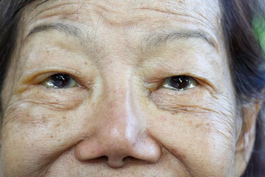eye edema in elderly woman