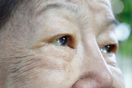 eye edema in elderly woman