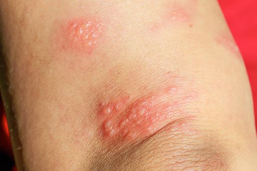 skin rash as allergic symptoms due to arm fiberglass cast