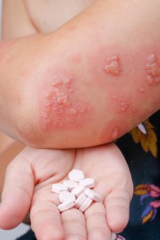 Shingles, Zoster or Herpes Zoster symptoms with antiviral drug