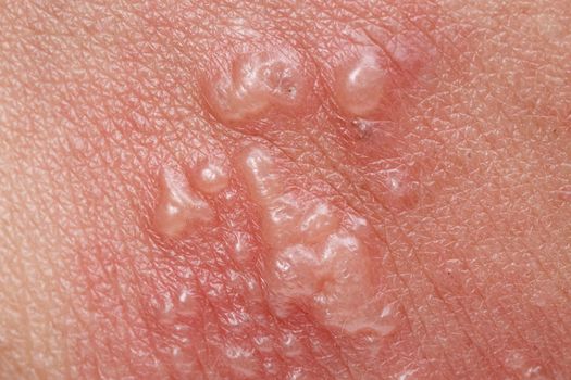 Shingles, Zoster or Herpes Zoster symptoms on arm