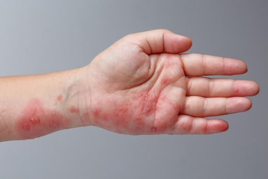 Shingles, Zoster or Herpes Zoster symptoms on arm