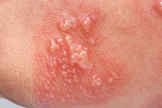 Shingles, Zoster or Herpes Zoster symptoms on arm