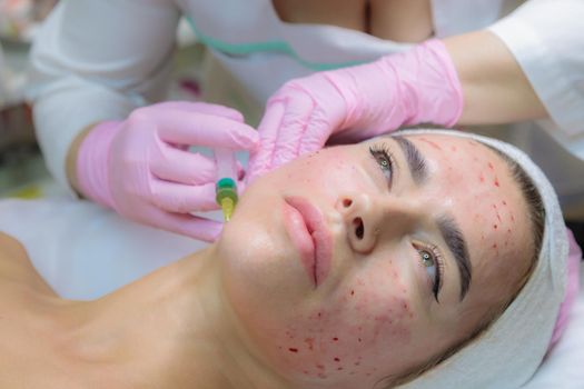 The doctor gives injections of blood plasma into the face of a young girl. Therapeutic procedure, plasmolifting