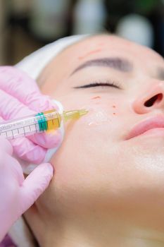 The doctor gives injections of blood plasma into the face of a young girl. Therapeutic procedure, plasmolifting