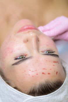 A young woman is wiped off traces of blood from a plasma injection on her face. Plasmolifting. Apply cream.