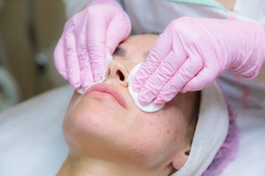 A young woman is wiped off traces of blood from a plasma injection on her face. Plasmolifting. Apply cream.