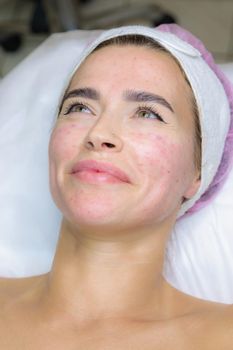 A young woman is wiped off traces of blood from a plasma injection on her face. Plasmolifting. Apply cream.