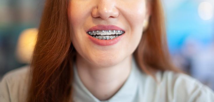 The smile of a young and beautiful girl with braces on her white teeth. Straightening of crooked teeth with the help of a bracket system. Malocclusion. Dental care. Smooth teeth and a beautiful smile