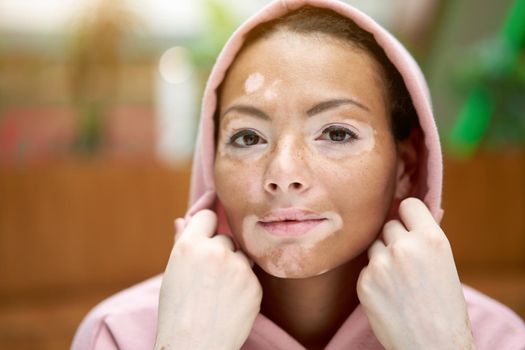 Black african american woman with vitiligo pigmentation skin problem indoor dressed pink hoodie put on a hood close up portrait with hand near face sad emotions melancholy mood