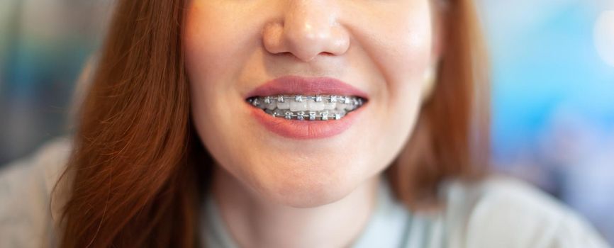 The smile of a young and beautiful girl with braces on her white teeth. Straightening of crooked teeth with the help of a bracket system. Malocclusion. Dental care. Smooth teeth and a beautiful smile