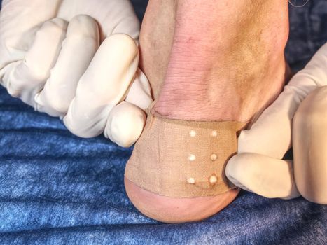 Leg of sports man with blister or burn wound on blue hospital background. Treatment of hurt place.
