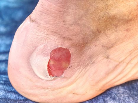 Detail of a fresh bloody blister on leg after sport accident.  Hot  and untouchable place on male skin. 