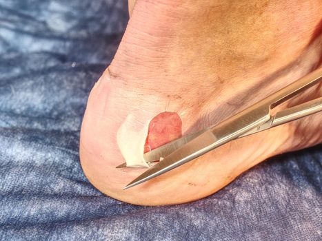 Nurse help to patient with abrasion on the skin on the heel, devastated skin from running sports shoes