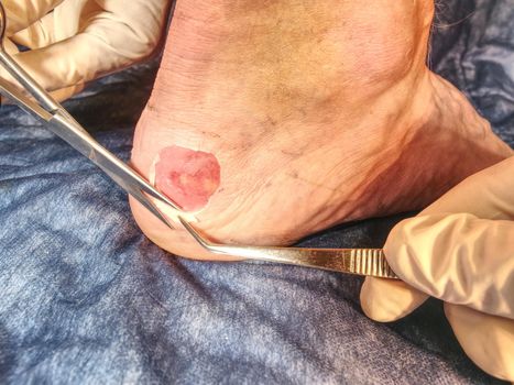 Hot painful place with bloody skin and wetted wound. Wet bloody abrasion on the skin beneath the ankle of a sports patient. 
