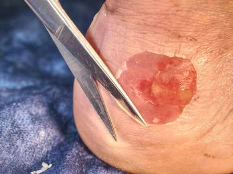 Abrasion with bloody blister. Deep wound on the skin. Scissors cut dead skin on patient heel.
