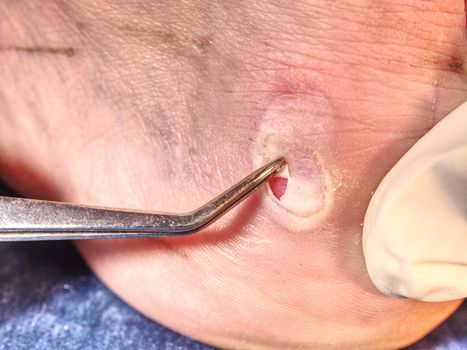 Small surgery on hurt leg, treatment of the wetting wound. Untouchable hot heel with burned skin. 