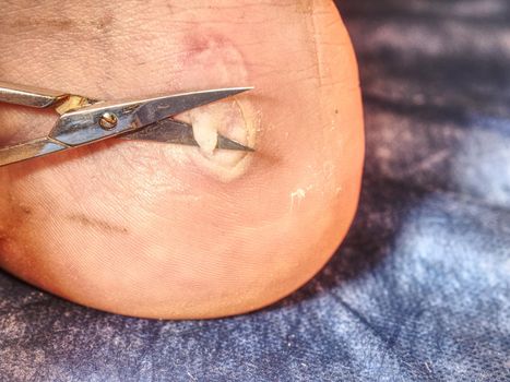 Abrasion with bloody blister. Deep wound on the skin. Scissors cut dead skin on patient heel.