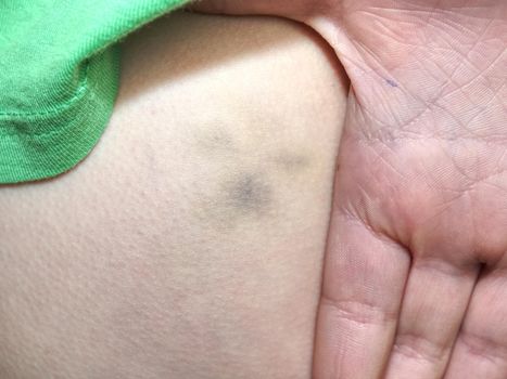 The green blue bruise  on kid body in green singlet. Kid palm and fingers