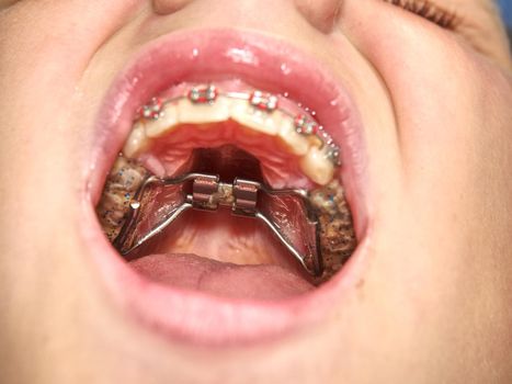 Mouth with retainer Braces for Teeth. Orthodontics Dental Theme Methods of Teeth (Bite) Correction. Hyrax and bonded expansion appliances