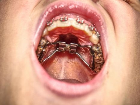 Dental braces in a young boy mouth. Teen with braces on his teeth. Macro shot of teeth with braces. Orthodontic Treatment. 