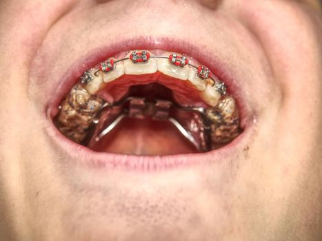 Prague, Czech Republic September 28th 2018.  Especial high palatal braces for correction of birth defect. Macro shot of teeth with braces. Orthodontic Treatment. 