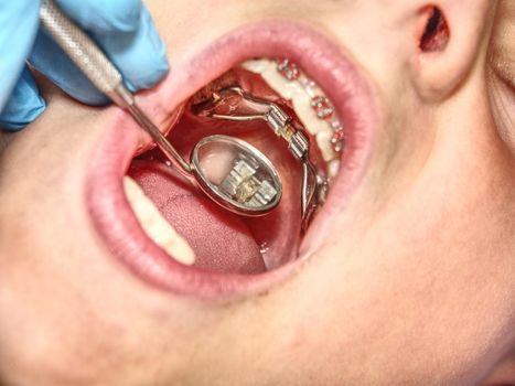 Prague, Czech Republic September 28th 2018. The Hyrax (Hygienic Rapid Expander) Banded designed as an upper arch rapid palatal expanding appliance.