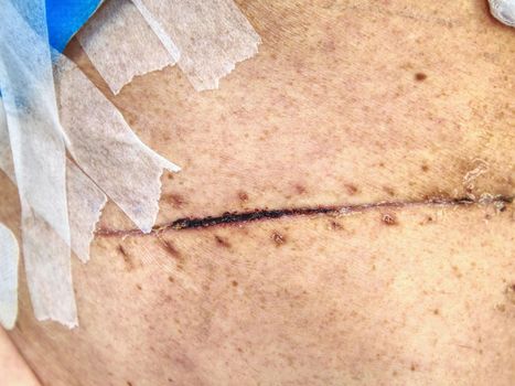 Father after cancer  liver and bowel cancer surgery. Bandage of fresh scar on the abdomen and side of male body.