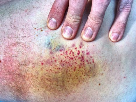 Bruised wound injury on human body. Patient show injured body with large paintful hematoma. 