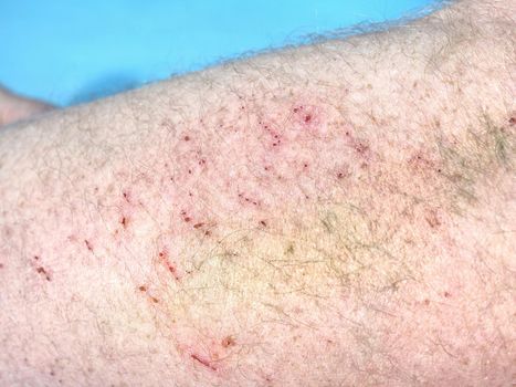 Detail of hematoma, cracked veins just below the surface of the skin. Painful incident.