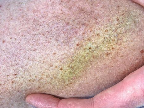 Large colorful bruise on human body. Painful hurt place after sporty incident. Detail of male body. Painful subcutaneous injury on human skin