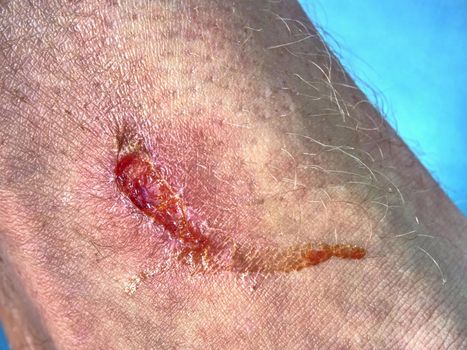 Fresh affected bloody skin.  Deep scratches on the skin with bruises and wet tracks