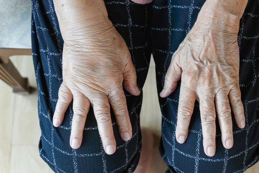 Elderly swollen hand or edema hand