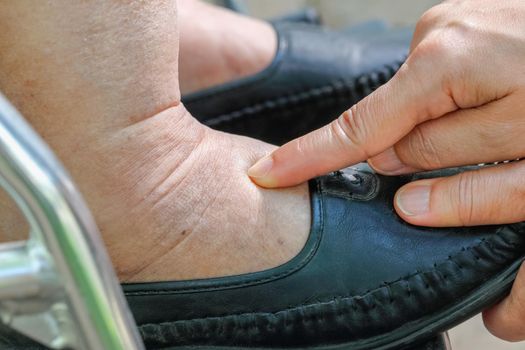 Swelling of ankles and feet test by pushing finger on swollen area will appear a pit.
