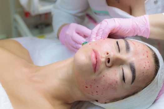 The doctor gives injections of blood plasma into the face of a young girl. Therapeutic procedure, plasmolifting
