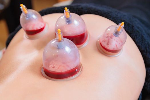 A hijama master performs a vacuum blood suction procedure for a young girl. Close-up