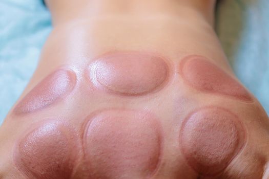 Traces after the hijama procedure on the body of a young girl. Close-up.