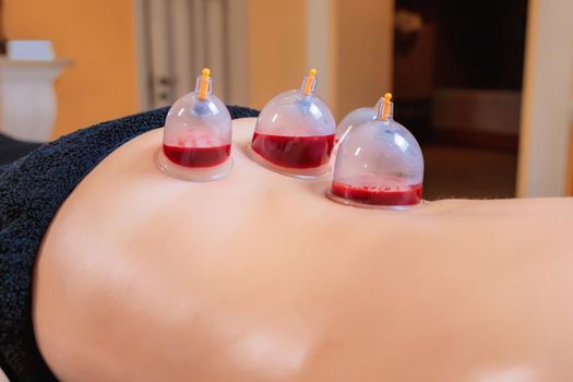 A hijama master performs a vacuum blood suction procedure for a young girl. Close-up