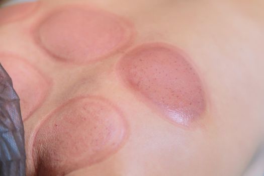 Traces after the hijama procedure on the body of a young girl. Close-up.
