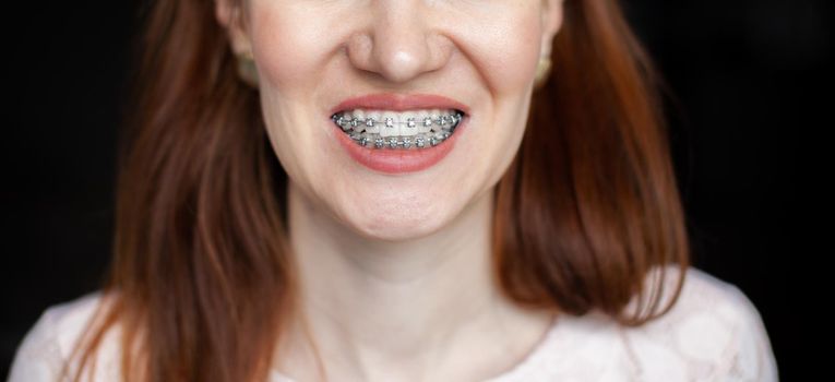 The smile of a young and beautiful girl with braces on her white teeth. Straightening of crooked teeth with the help of a bracket system. Malocclusion. Dental care. Smooth teeth and a beautiful smile