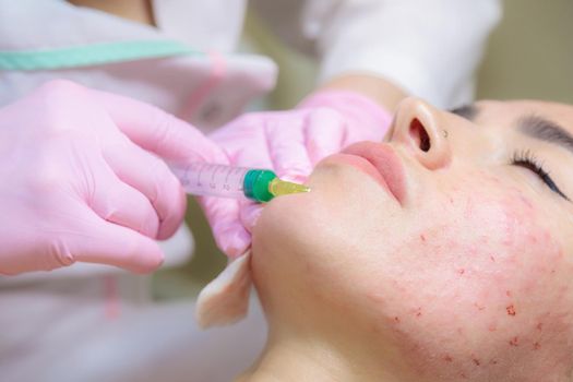 The doctor gives injections of blood plasma into the face of a young girl. Therapeutic procedure, plasmolifting