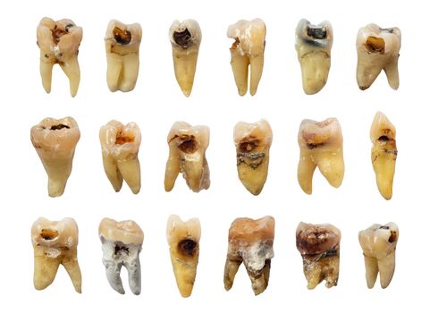 Set of teeth with dental caries ( tooth decay ) , fluorosis and calculus . isolated background .
