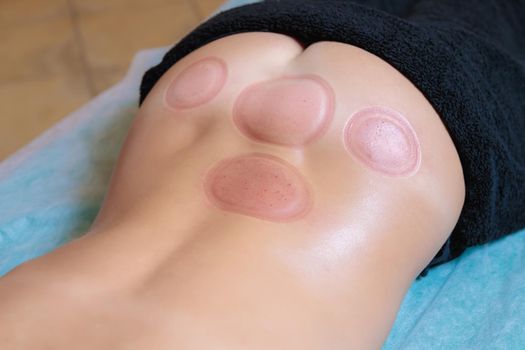 Traces after the hijama procedure on the body of a young girl. Close-up.