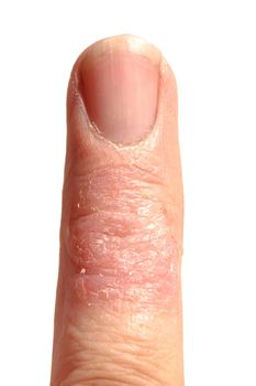 Eczema dermatitis allergic skin rash close-up region on adult finger. Isolated on white background.