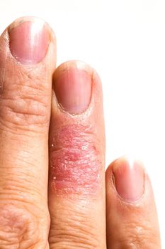 Eczema dermatitis allergic skin rash close-up region on adult finger. Isolated on white background.