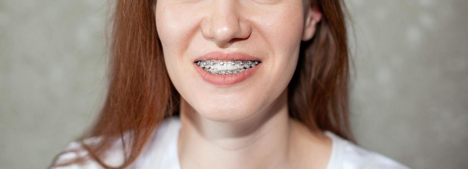 The smile of a young girl with braces on her white teeth. Teeth straightening. Malocclusion. Dental care. 