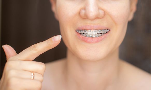 The girl points her finger at the even and white teeth with braces. Straightening your teeth with braces. Dental care. Smooth teeth and a beautiful smile